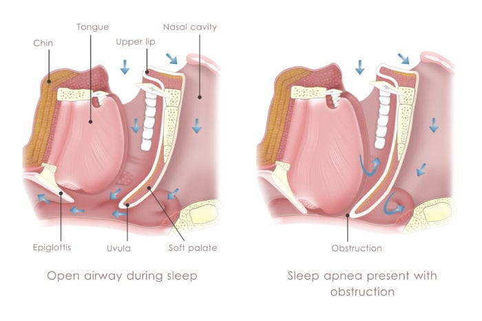 sleep apnea snoring stop snoring treatment for sleep apnea claremont ca