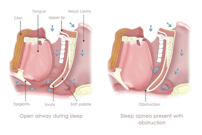 sleep apnea treatment in Claremont California