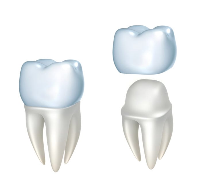 affordable dental crowns in Claremont California