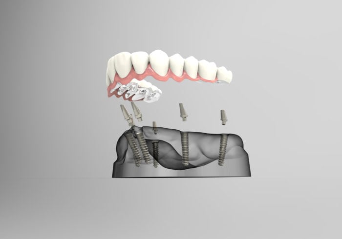 implant-secured dentures for missing teeth in Claremont California