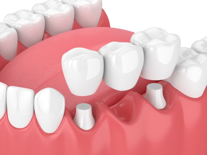 affordable dental bridges in Claremont, CA to replace missing teeth