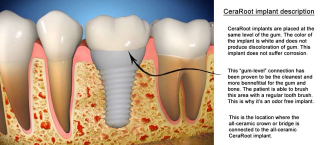 CeraRoot ceramic implants at Claremont Dental Institute