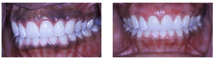 before and after gum bleaching results