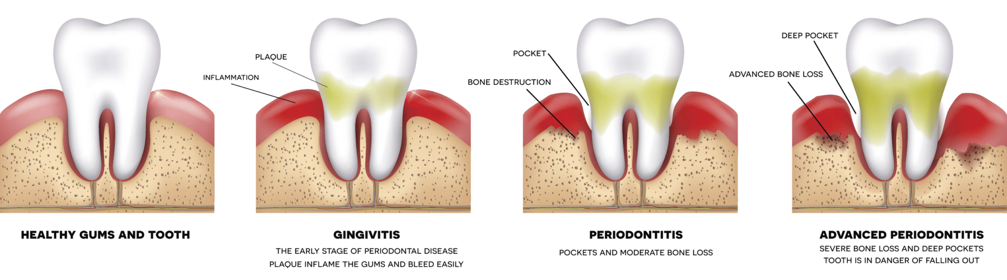 bleeding gum treatment in Claremont CA