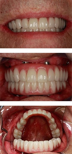 Claremont Dental Institute dental implant results