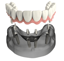 dental implant-secured denture with Implant dentist in Claremont CA