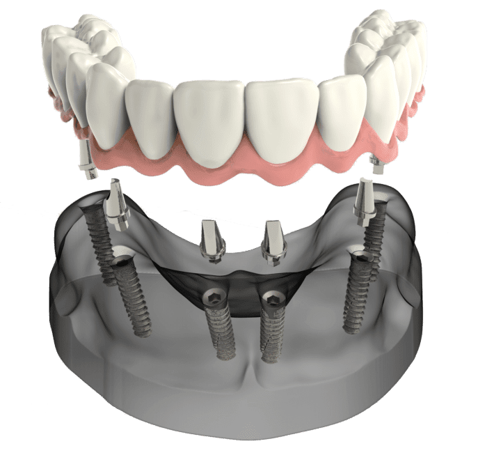 dental implants for replacing many lost teeth in Claremont California