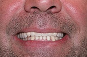 teeth reconstruction with cosmetic dentist in Claremont CA