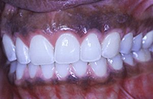 Claremont CA gum bleaching for a brighter smile
