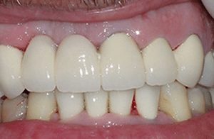 Smile reconstruction procedure in Claremont CA