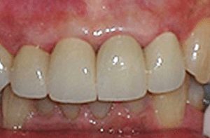 results after replacing old dental implants at Claremont Dental Institute