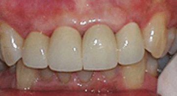 results after replacing old dental implants at Claremont Dental Institute