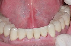 smile makeover for damaged teeth results in Claremont CA
