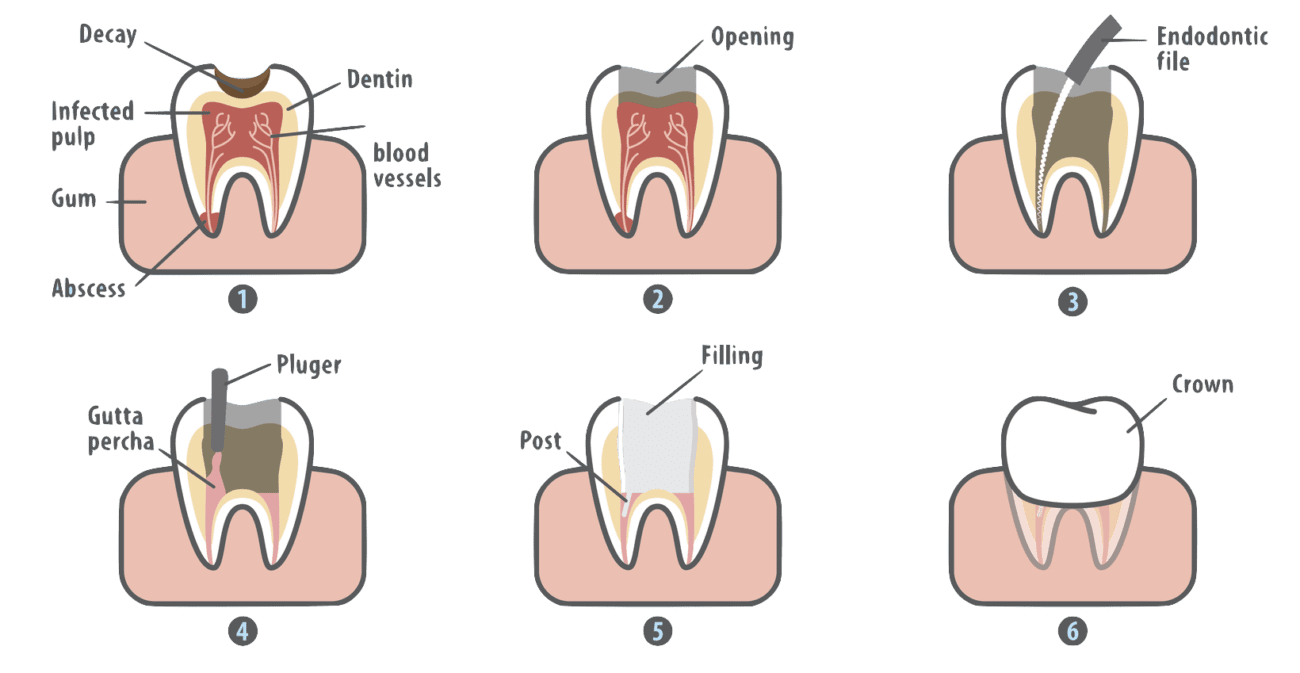 root canal procedure claremont ca endodontics
