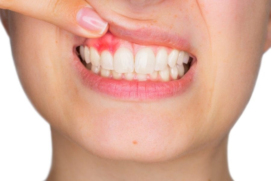 Why Do My Gums Bleed? Claremont CA Dentist