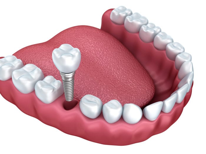 A type of single dental implant