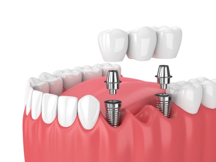 dental implant-supported bridges in Claremont California