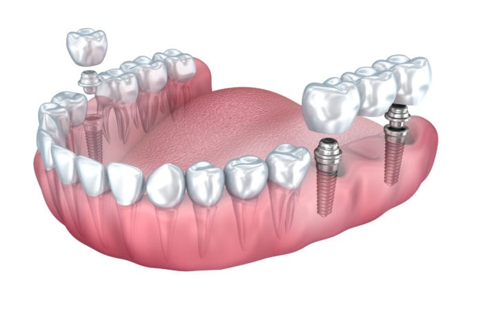 dental implants claremont ca