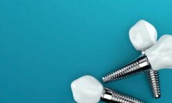 claremont, california dental implants