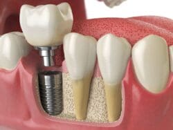 claremont, ca dental implants