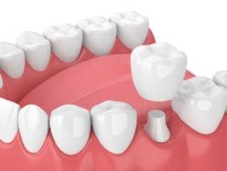affordable dental crowns in claremont, california