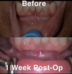 Before and After a Laser Frenectomy at Claremont Dental Institute