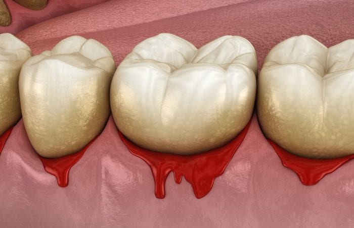 Don't Ignore Bleeding Gums During the Pandemic