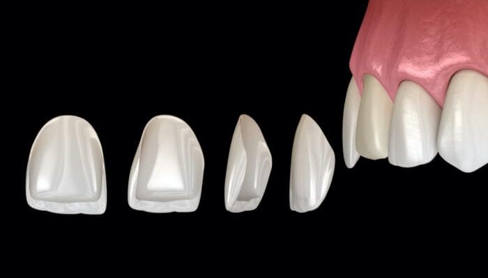 teeth bonding and porcelain veneers in claremont, california