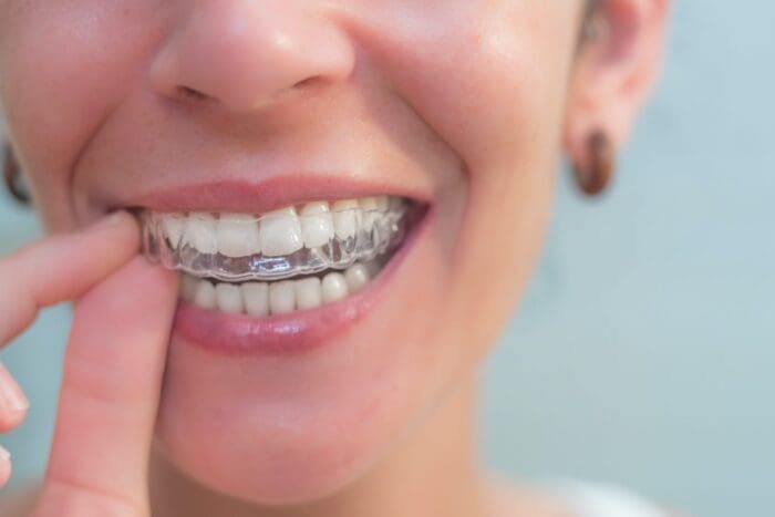 permanent invisalign treatment in claremont, california