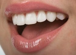 laser teeth whitening in Claremont, California