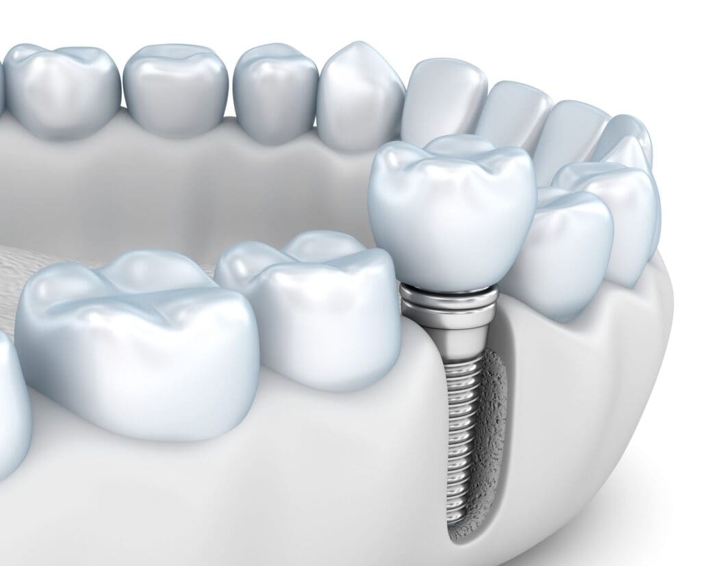 Protect Your Jaw After Tooth Loss