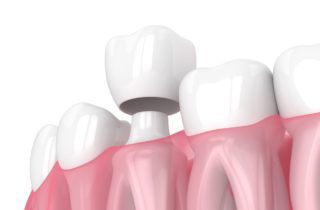 restore damaged teeth with dental crowns