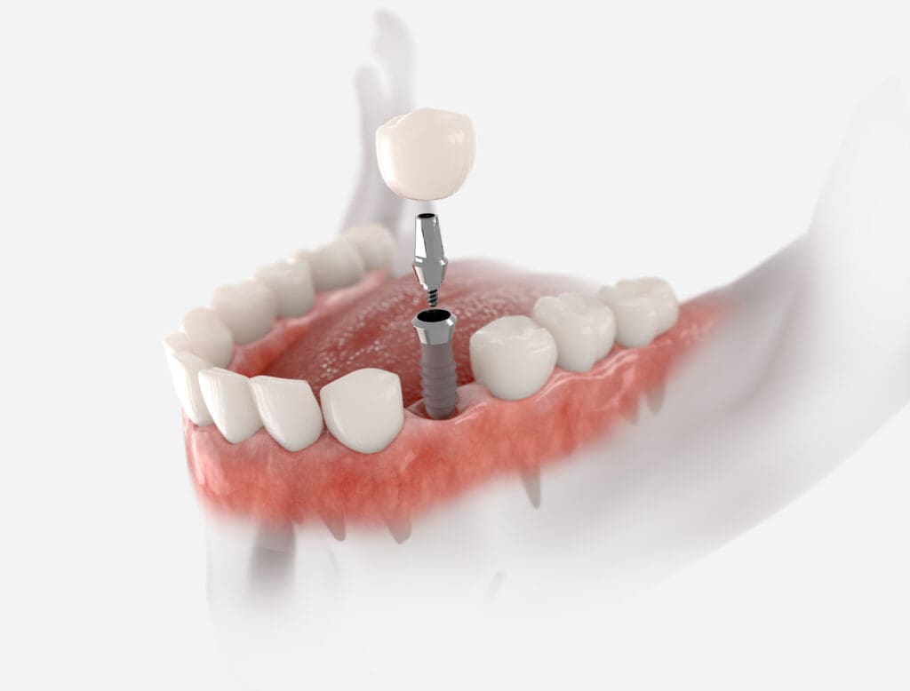 A type of single dental implant