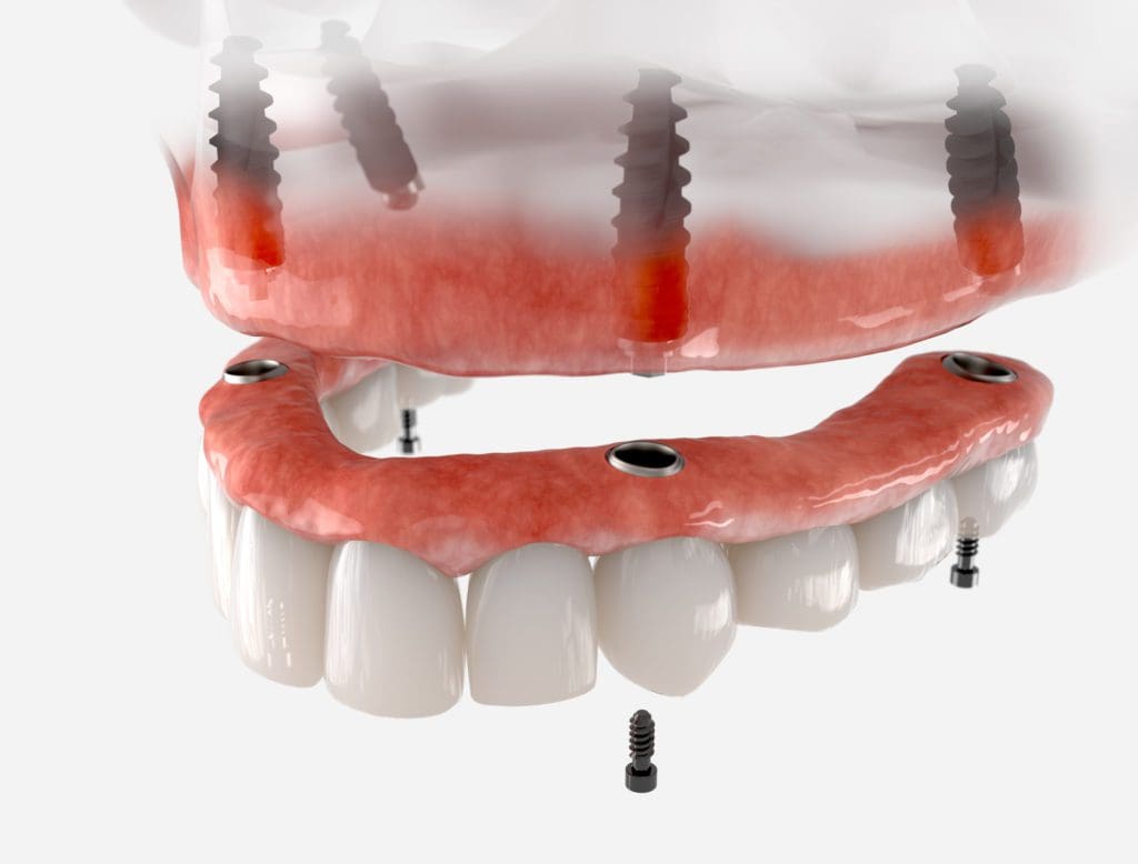 dental implant-supported bridges in Claremont California