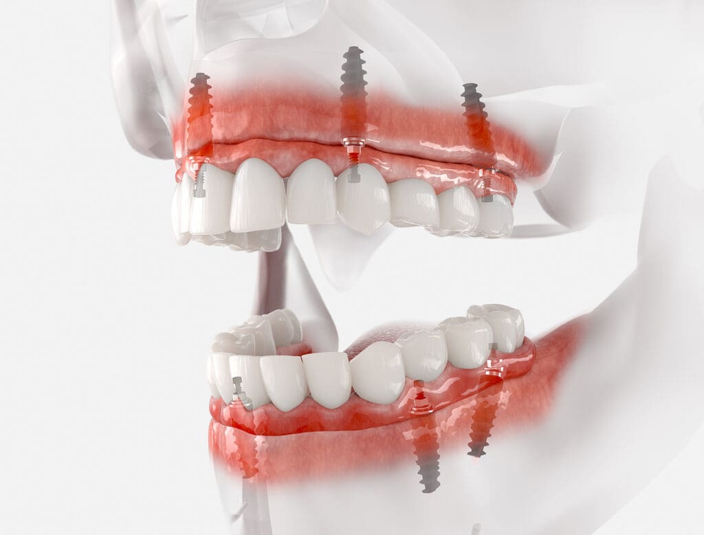 dental implants for replacing many lost teeth in Claremont California