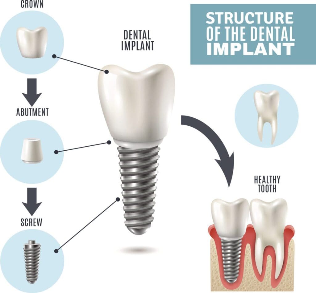 dental implant claremont ca