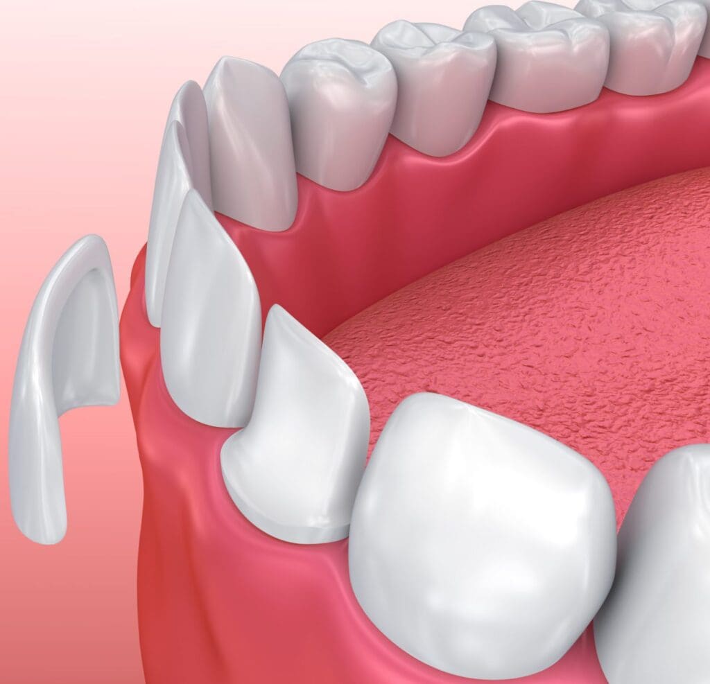 Porcelain Veneers in Claremont, CA