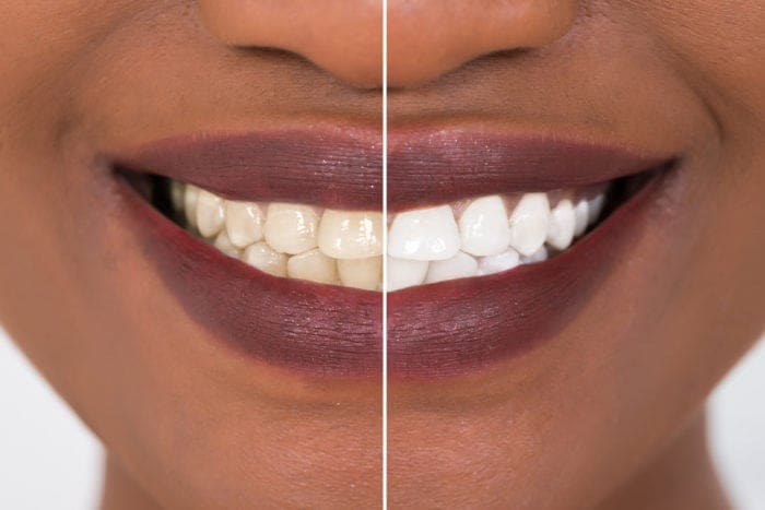teeth whitening in Claremont California