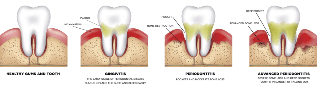 bleeding gum treatment in Claremont CA