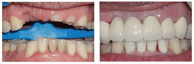 Dental patient before and after implant-supported bridge