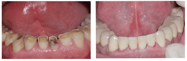 Dental patient before and after restorative dentistry