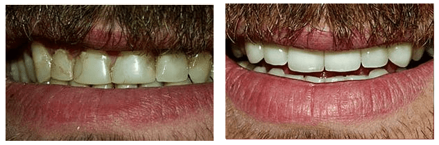 Dental patient before and after teeth whitening