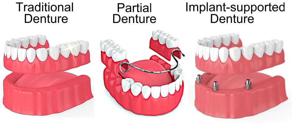 Dental Implants Vs. Dentures