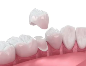 How Same-Day Crowns Work (Without the Wait) in Claremont, CA