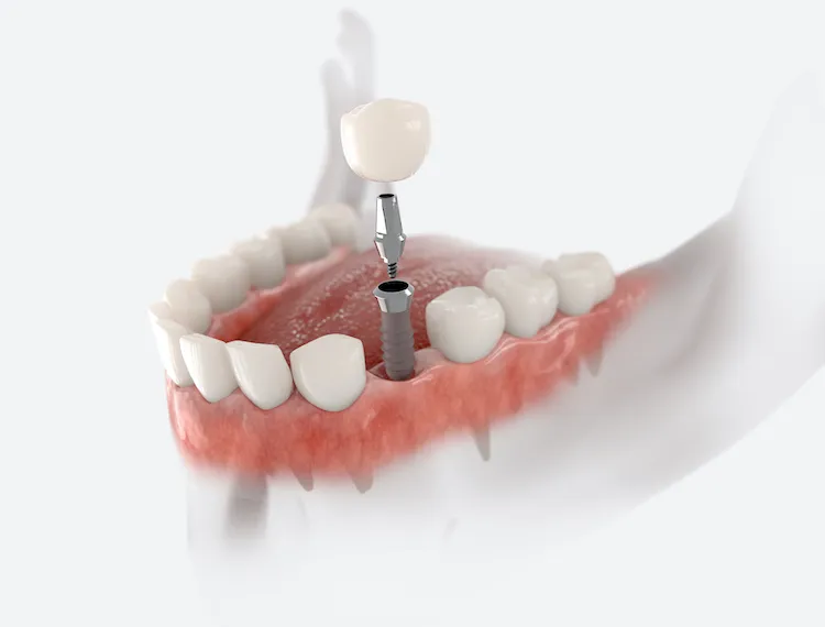Does Getting a Dental Implant Hurt? in Claremont, CA